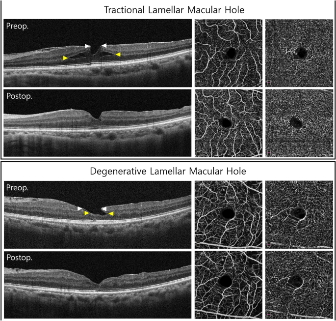 Optical coherence tomography angiographic findings of lamellar macular hole:  comparisons between tractional and degenerative subtypes | Scientific  Reports