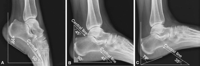 Inter- and Intra-observer Reliability of a New Classification System for  Calcaneus Fracture Malunions: The ADEINS Classification | Indian Journal of  Orthopaedics