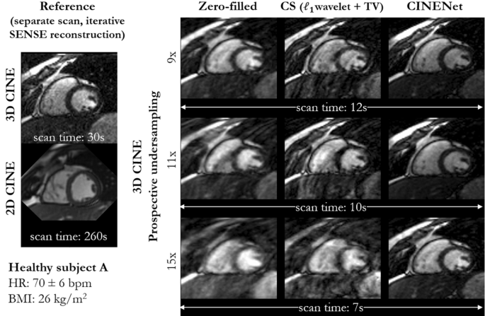 CINENet: deep learning-based 3D cardiac CINE MRI reconstruction with  multi-coil complex-valued 4D spatio-temporal convolutions | Scientific  Reports