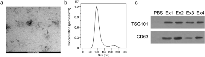 Upregulation of circ_0000199 in circulating exosomes is associated with survival outcome in oscc