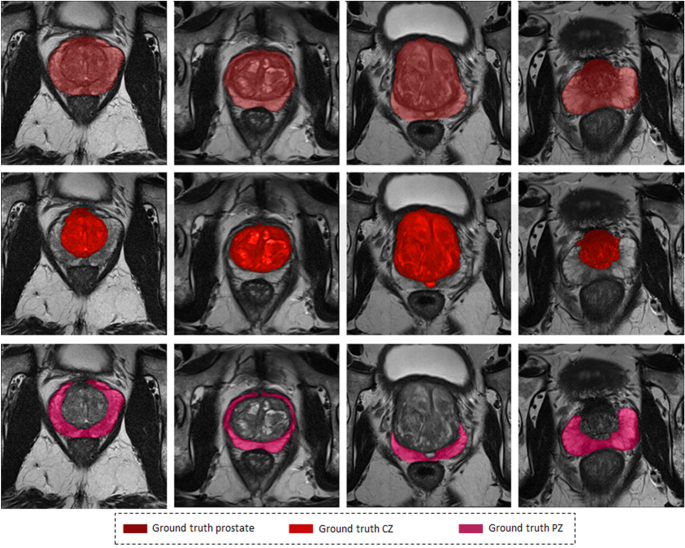 prostate gland anatomy mri