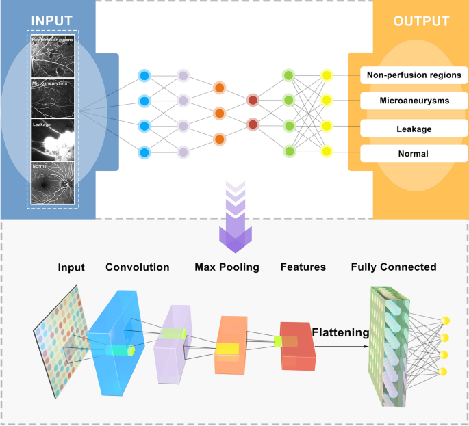 Automatic detection of non-perfusion areas in diabetic macular edema from fundus fluorescein angiography for decision making using deep learning