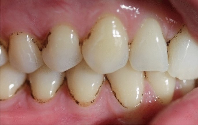 Differentiating Between Plaque and Tartar