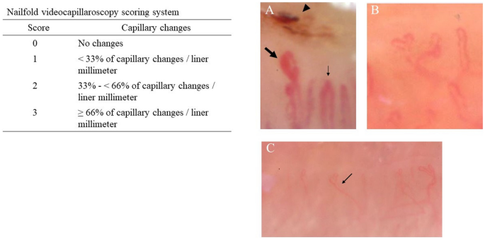 Nailfold Capillaroscopy a Non-Invasive Tool for Direct Observation of  Microvascular Damage in Diabetes Mellitus: Review