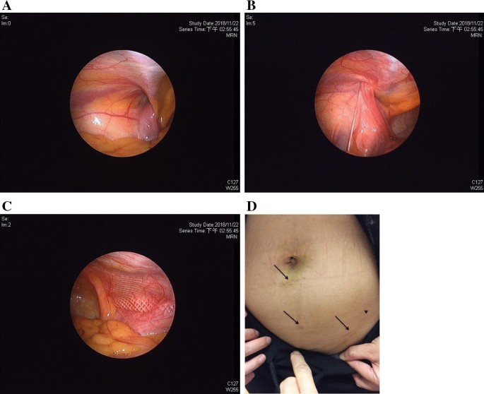 The application of single-port laparoscopic percutaneous internal ring  suture for the management of indirect inguinal hernia in female adults