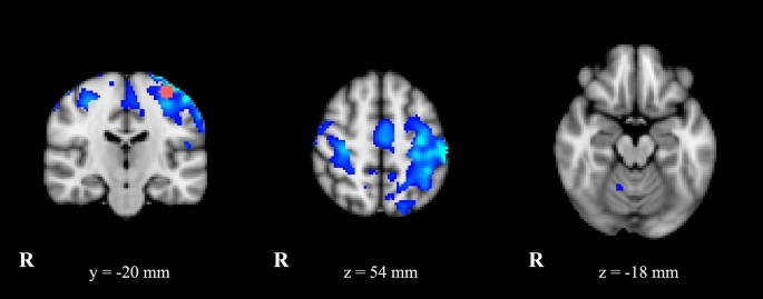 Cerebello Thalamo Cortical Network Is Intrinsically Altered In Essential Tremor Evidence From A Resting State Functional Mri Study Scientific Reports Cerebello Thalamo Cortical Network Is Intrinsically Altered In Essential Tremor Evidence From A Resting State Functional Mri Study Scientific Reports