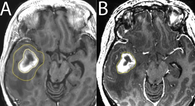 Quantitative MRI using relaxometry in malignant gliomas detects contrast  enhancement in peritumoral oedema | Scientific Reports