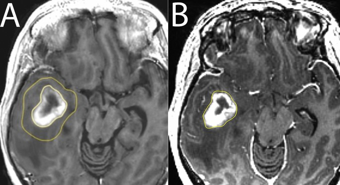 brain scan with tumor