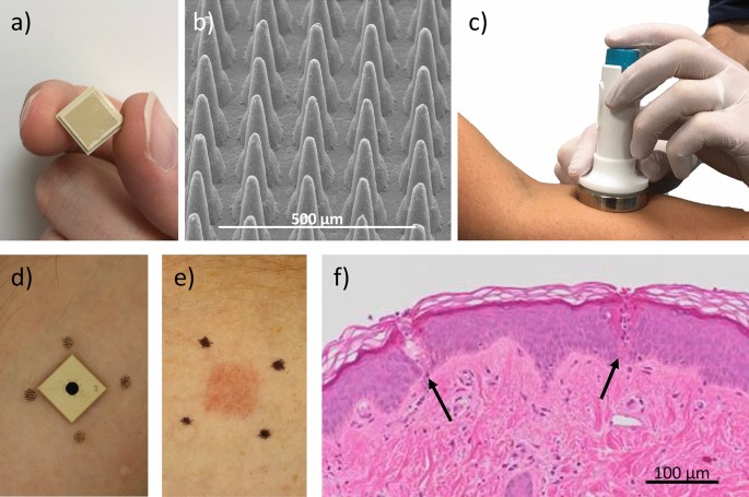Innate local response and tissue recovery following application of high  density microarray patches to human skin | Scientific Reports