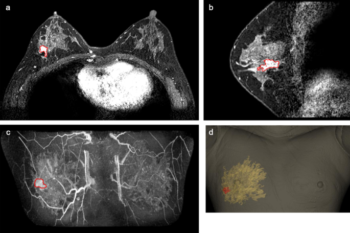 Magnetic resonance imaging based 3-dimensional printed breast surgical  guide for breast-conserving surgery in ductal carcinoma in situ: a clinical  trial | Scientific Reports