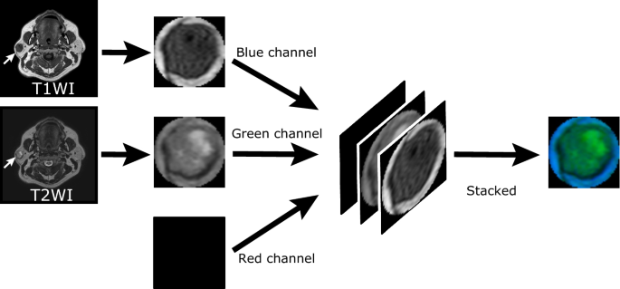 Diagnostic Accuracy Of Deep Learning With Anomaly Detection For A Small Amount Of Imbalanced Data Discriminating Malignant Parotid Tumors In Mri Scientific Reports