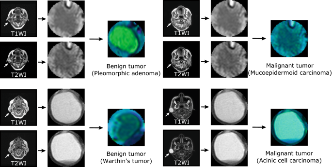 Leveraging Datature Nexus for Tumor and Anomaly Detection in Medical Scans  : Part I