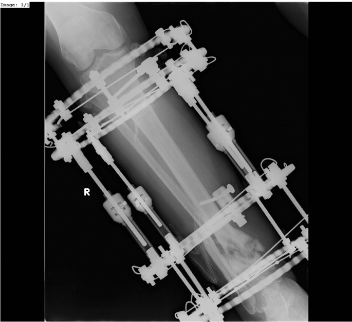 THE MANAGEMENT OF INFECTED NONUNION TIBIA SHAFT WITH ILIZAROV RING