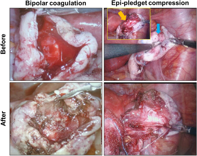 Epinephrine minimizes the use of bipolar coagulation and preserves ovarian  reserve in laparoscopic ovarian cystectomy: a randomized controlled trial
