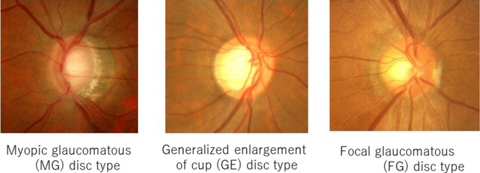 antrenament volumetric al vederii miopie și hipermetropie boală oculară