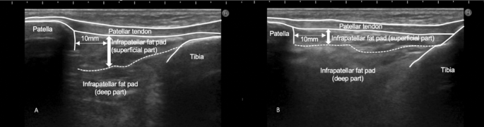 Flexibility of infrapatellar fat pad affecting anterior knee pain 6 months  after anterior cruciate ligament reconstruction with hamstring autograft |  Scientific Reports