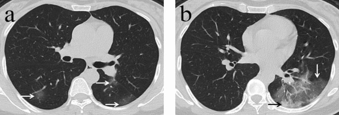 Correlation Between Ct Findings And Outcomes In 46 Patients With Coronavirus Disease 2019 Scientific Reports