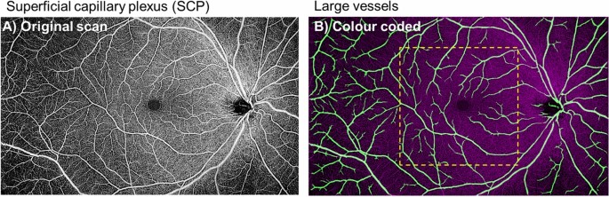 Effect Of Vessel Enhancement Filters On The Repeatability Of Measurements Obtained From Widefield Swept Source Optical Coherence Tomography Angiography Scientific Reports