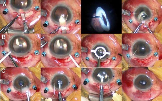 Long-term surgical outcomes of primary retropupillary iris claw intraocular  lens implantation for the treatment of intraocular lens dislocation |  Scientific Reports