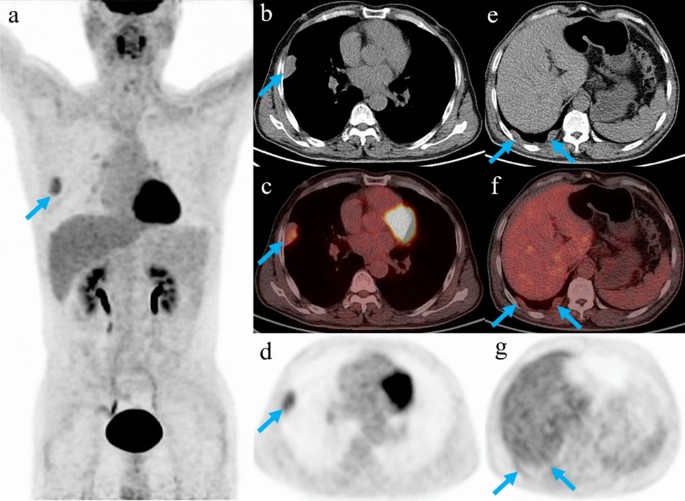 Diagnostic and prognostic value of FDG PET-CT in patients with suspected  recurrent thymic epithelial tumors | Scientific Reports