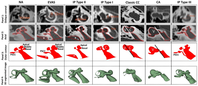 A novel method of identifying inner ear malformation types by pattern  recognition in the mid modiolar section