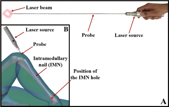 Applied Sciences | Free Full-Text | Extraction of Broken Interlocking  Tibial Nails: A Review of Surgical Techniques and Practical Management