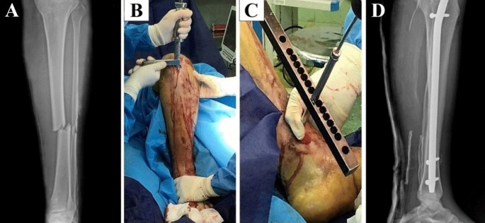 Fracture Treatment using Tibia Nail Advanced System for the 1st time in  India | MIOT International