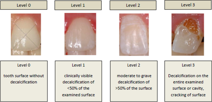 A novel method quantifying caries following orthodontic treatment