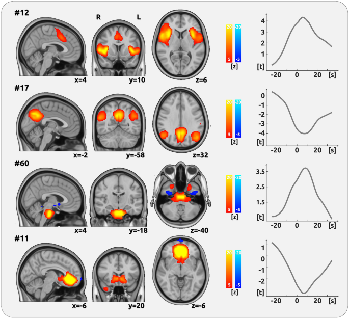 The Role of the Prefrontal Cortex in Chronic Pain - The Pain PT