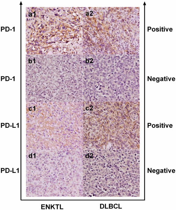 The expression and clinical significance of programmed cell death receptor 1 and its ligand in tumor tissues of patients with extranodal nasal nk/t cell lymphoma