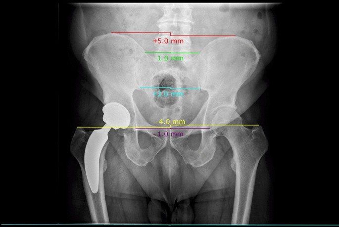 Leg Length Measures Appear Inaccurate In The Early Phase Following Total Hip  Arthroplasty | Scientific Reports