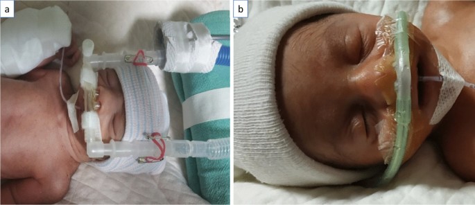 RAM cannula with Cannulaide versus Hudson prongs for delivery of nasal  continuous positive airway pressure in preterm infants: an RCT | Scientific  Reports