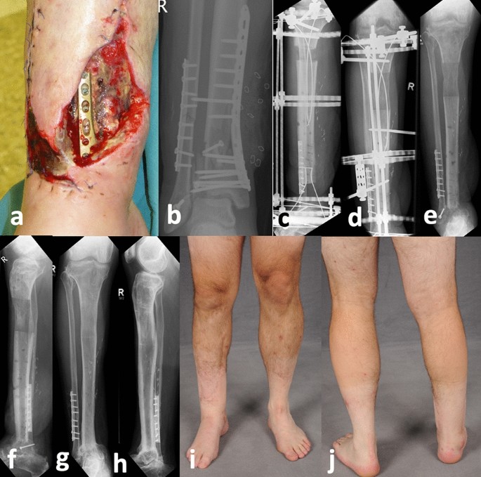 The outcomes of Ilizarov treatment in aseptic nonunions of the tibia  stratified by treatment strategies and surgical techniques