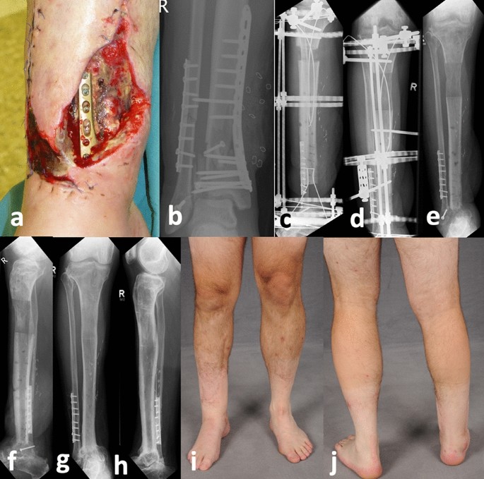 Analysis of bone transport for ankle arthrodesis as a limb salvage  procedure for the treatment of septic pilon fracture nonunion