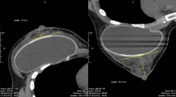 External-beam partial breast irradiation in a supine versus prone position  after breast-conserving surgery for Chinese breast cancer patients