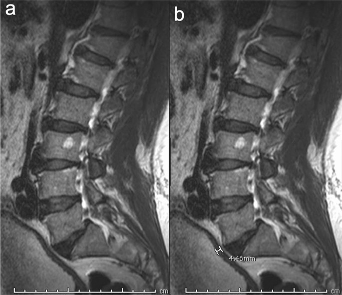 Extraspinal findings prevalence and clinical significance in 4250 lumbar  spine MRI exams
