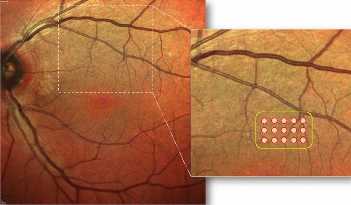 Subthreshold laser treatment for reticular pseudodrusen secondary to  age-related macular degeneration | Scientific Reports