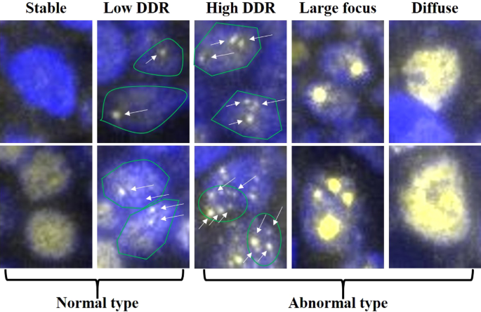 Significance of abnormal 53bp1 expression as a novel molecular pathologic parameter of follicular-shaped b-cell lymphoid lesions in human digestive tract