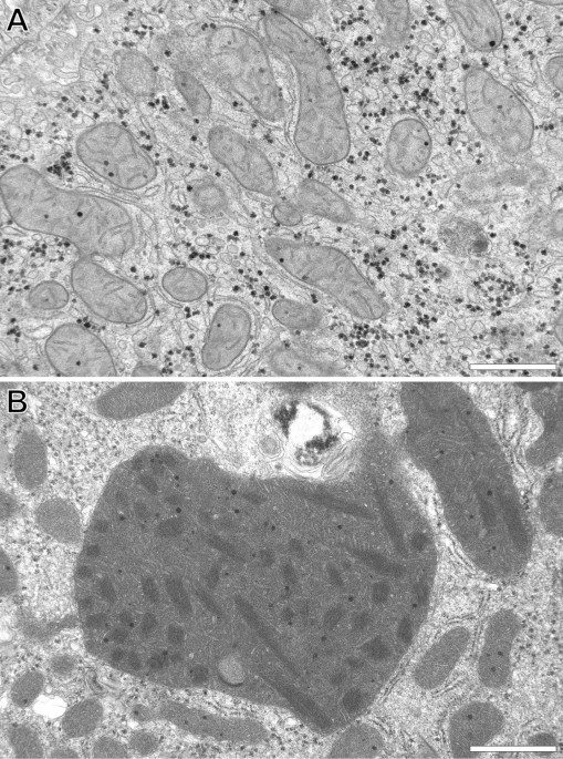 Three-dimensional ultrastructure of giant mitochondria in human  non-alcoholic fatty liver disease | Scientific Reports