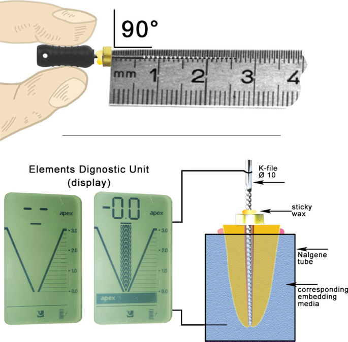Influence Of Embedding Media On The Accuracy Of Working Length Determination By Means Of Apex Locator An Ex Vivo Study Scientific Reports