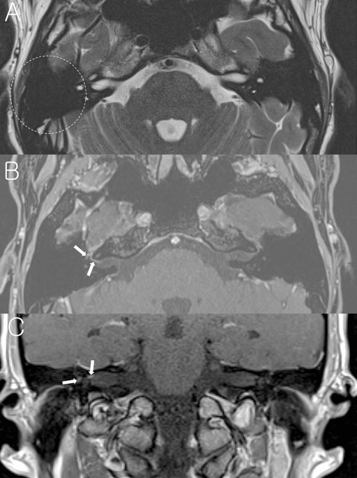 Mastoid effusion on temporal bone MRI in patients with Bell's palsy and  Ramsay Hunt syndrome | Scientific Reports