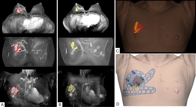 Usefulness Of 3d Surgical Guides In Breast Conserving Surgery After Neoadjuvant Treatment Scientific Reports Usefulness Of 3d Surgical Guides In Breast Conserving Surgery After Neoadjuvant Treatment Scientific Reports