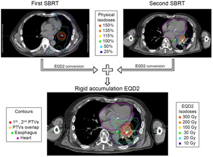 In-field stereotactic body radiotherapy (SBRT) reirradiation for pulmonary  malignancies as a multicentre analysis of the German Society of Radiation  Oncology (DEGRO) | Scientific Reports