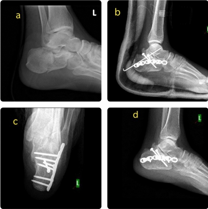 Part 2 - Calcaneus - Heel fracture (March 2012) - YouTube