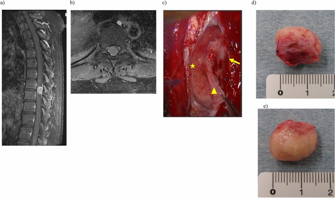 Surgical results of the resection of spinal meningioma with the inner layer  of dura more than 10 years after surgery | Scientific Reports