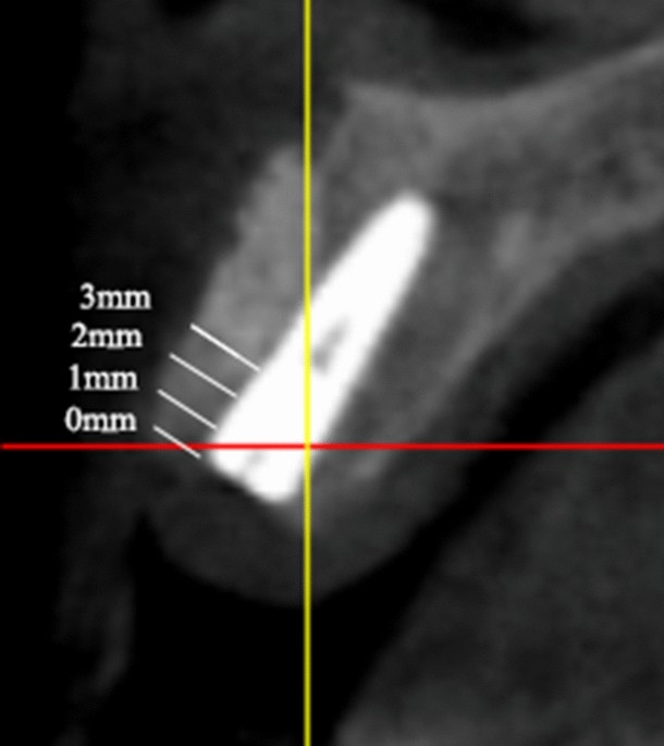 PDF] Implant bone rings. One-stage three-dimensional bone transplant  technique: a case report. | Semantic Scholar