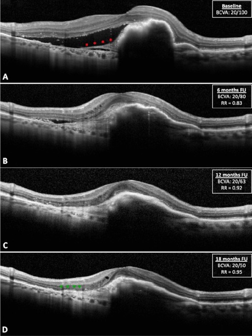 Optical coherence tomography features of the repair tissue following RPE  tear and their correlation with visual outcomes