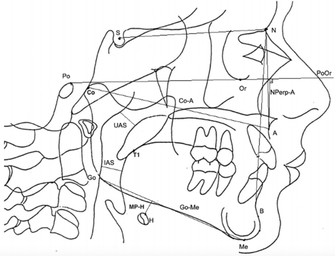 Cephalometric measures correlate with polysomnography parameters in individuals with midface deficie