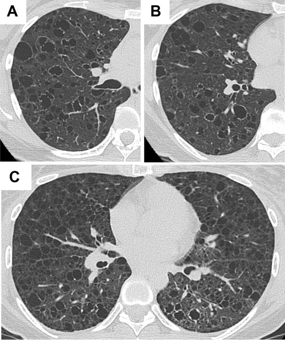Uncommon radiologic computed tomography appearances of the chest in  patients with lymphangioleiomyomatosis | Scientific Reports
