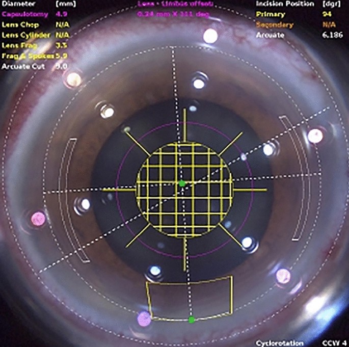 Comparison of penetrating femtosecond laser-assisted astigmatic keratotomy  and toric intraocular lens implantation for correction of astigmatism in cataract  surgery | Scientific Reports